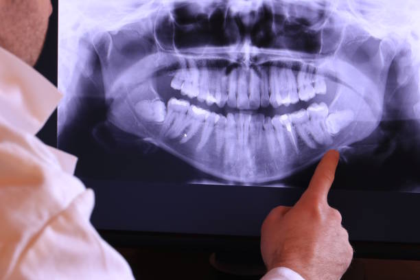 Best Emergency Root Canal Treatment in Gibson City, IL